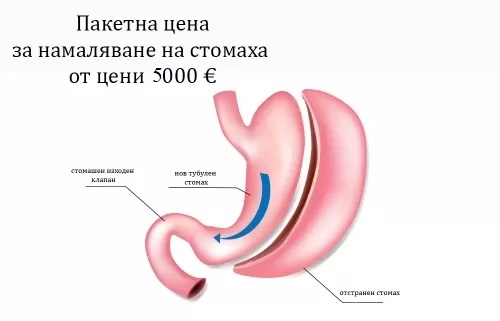 Стомашна хирургия